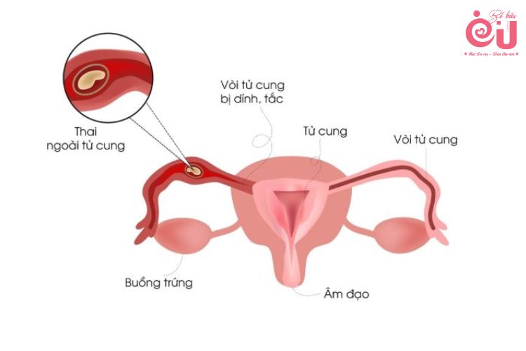 Mang thai ngoài tử cung là tình trạng nguy hiểm với sức khỏe sinh sản