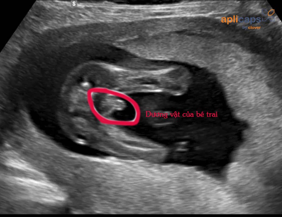 Hình ảnh bộ phận sinh dục thai nhi 12 tuần đến 16 tuần