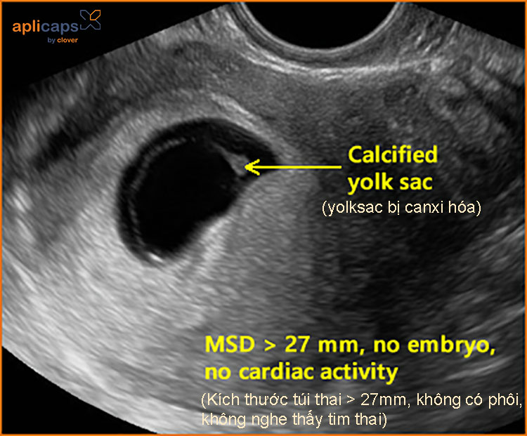 thai 7 tuần có yolksac chưa có phôi