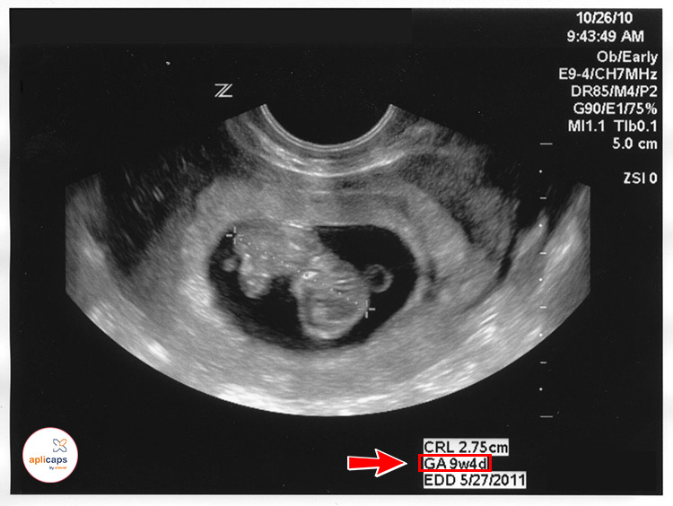 hình ảnh siêu âm thai nhi 9 tuần tuổi 9w4d