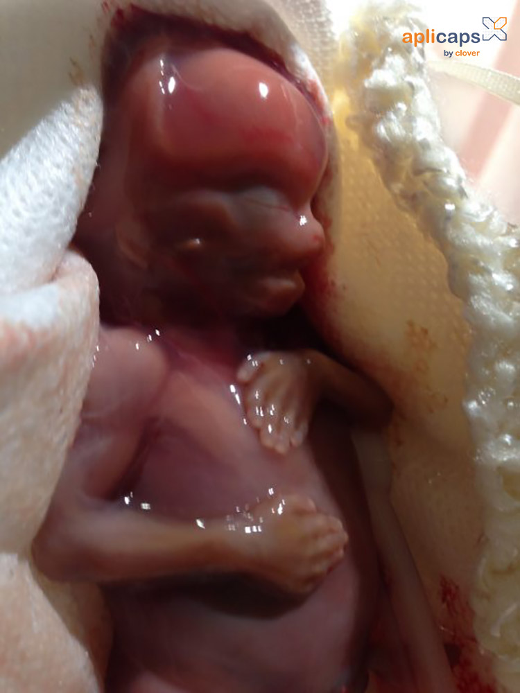 hình ảnh túi thai bị sảy 16 tuần