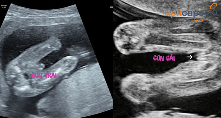 Với hình ảnh siêu âm, bạn sẽ biết được giới tính của đứa bé mà mình đang mang trong lòng. Bạn còn có thể chứng kiến quá trình phát triển của bé bên trong bụng mẹ. Hãy trải nghiệm cảm giác tuyệt vời này!