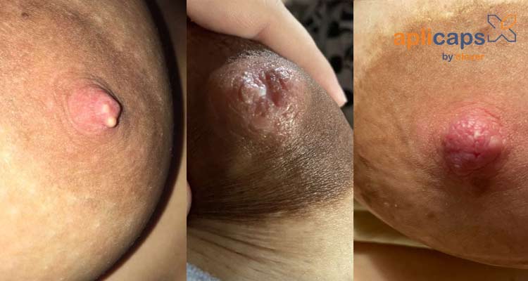 Sữa non tiết ra bới số lượng bất kỳ