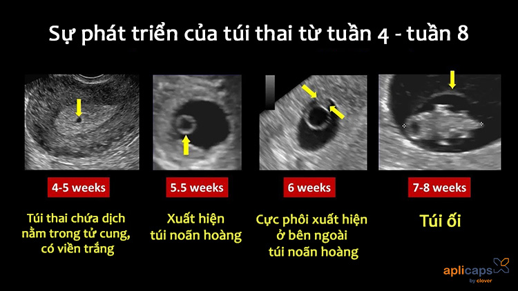 hình ảnh túi thai 5 tuần đến 8 tuần