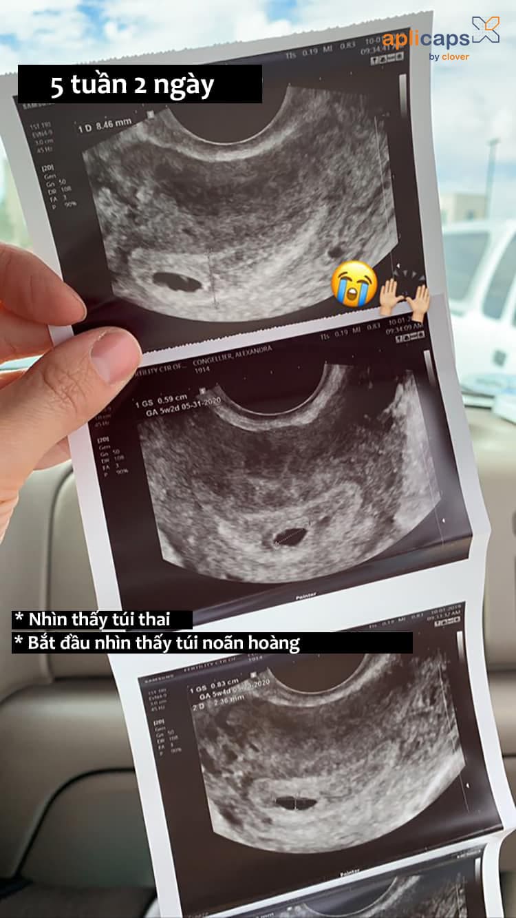 Xem hình ảnh siêu âm thai đơn 5 tuần sẽ khiến bạn cảm thấy rất hạnh phúc và thú vị vì đó là giai đoạn đáng nhớ trong cuộc đời mẹ bầu. Hãy khám phá những tiếng đập tim đầu tiên của con bạn và cảm nhận tình yêu mãnh liệt đang chờ đón bạn.