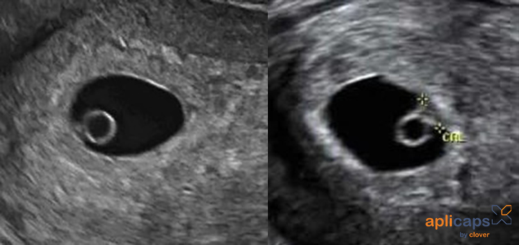 hình ảnh túi thai 5 tuần 2