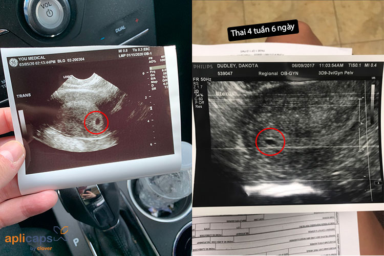 hình ảnh siêu âm thai 4 tuần tuổi 1