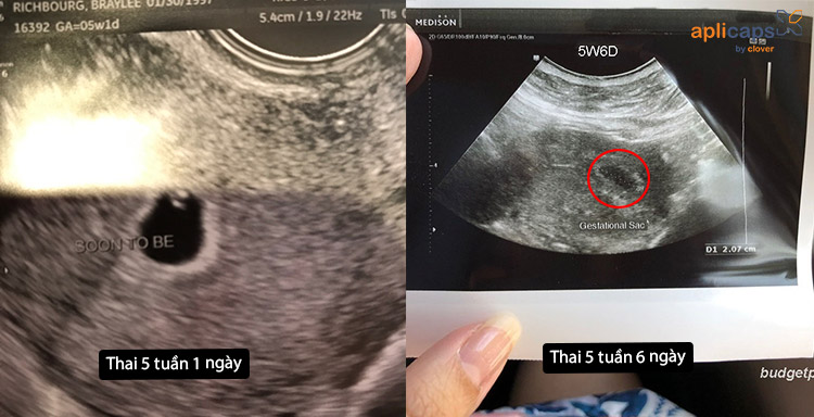 Hình ảnh siêu âm thai 5 tuần tuổi 