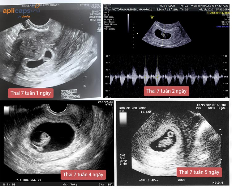 Hình ảnh siêu âm thai 7 tuần tuổi