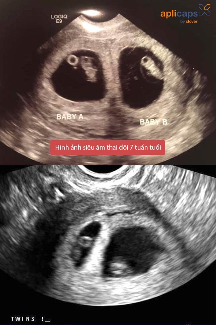 Hình ảnh siêu âm thai 7 tuần tuổi - thai đôi