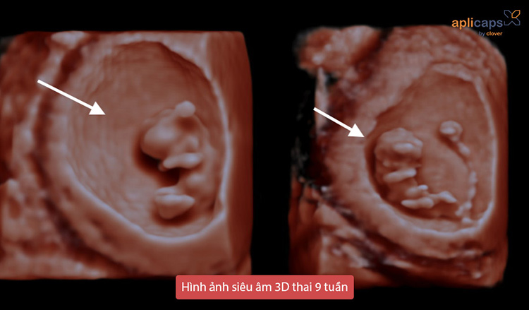 Hình ảnh siêu âm 3D thai 9 tuần tuổi