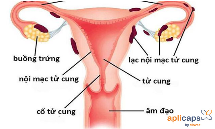 Hình ảnh lạc nội mạc tử cung