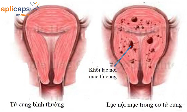 Khối lạc nội mạc tử cung trong cơ