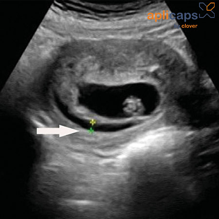 Hình ảnh siêu âm thai nhi bị tụ dịch màng nuôi