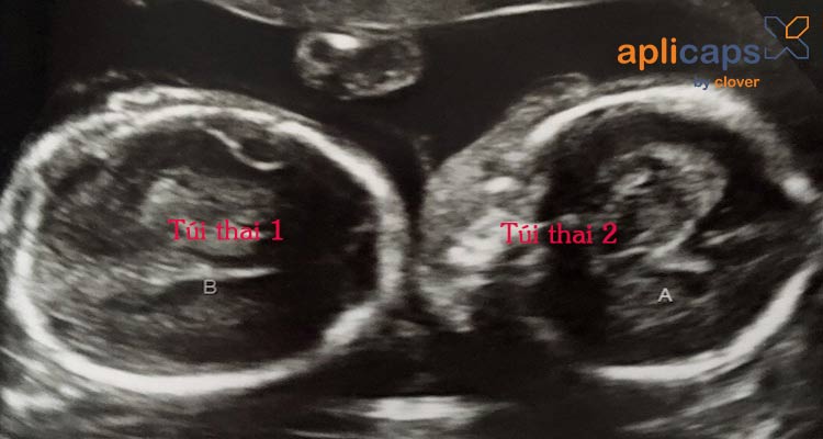 hình ảnh siêu âm thai đôi 4 tuần tuổi