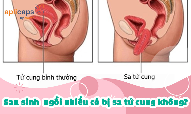 sau-sinh-ngoi-nhieu-co-bi-sa-tu-cung-khong