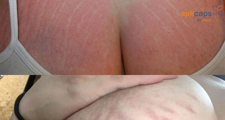 Rạn da do ngực phát triển khi mang thai