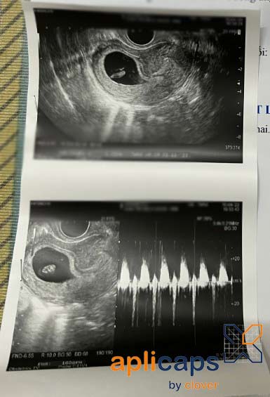 Hình ảnh siêu âm khi mang thai 2 tháng