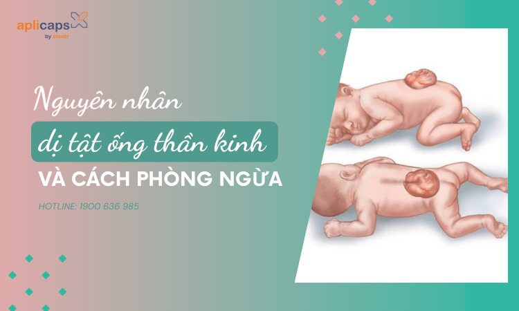 Nguyên nhân dị tật ống thần kinh và cách phòng ngừa