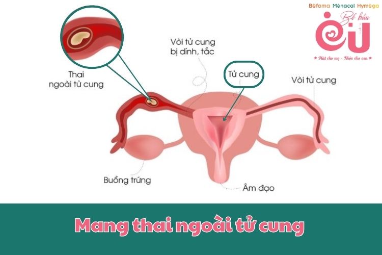 Nồng độ Beta hCG sau sảy thai không giảm khi mang thai ngoài tử cung