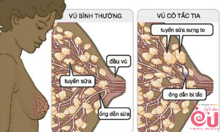 Viêm vú gây đau đầu ti khi cho con bú