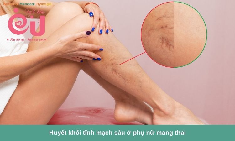 Mẹ bầu thường bị giãn tĩnh mạch. 