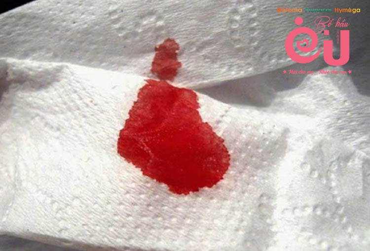 Màu máu đỏ tươi có thể là dấu hiệu dọa sảy thai hay nhau tiền đạo