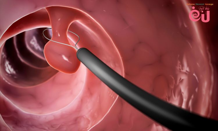 Polyp tử cung hoặc cổ tử cung là nguyên nhân bệnh lý nghiêm trọng khiến bầu 4 tháng ra máu nhưng không đau bụng