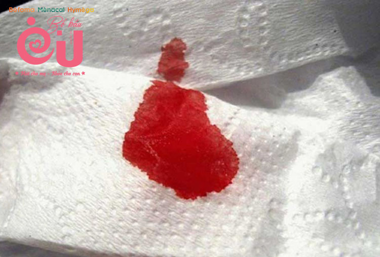 Có trường hợp bị chảy máu từ nguồn ngoài buồng tử cung không gây đau bụng