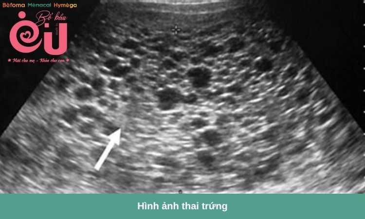 Hình ảnh siêu âm thai trứng