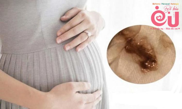 Ra máu trong 3 tháng đầu thai kỳ là hiện tượng khá phổ biến