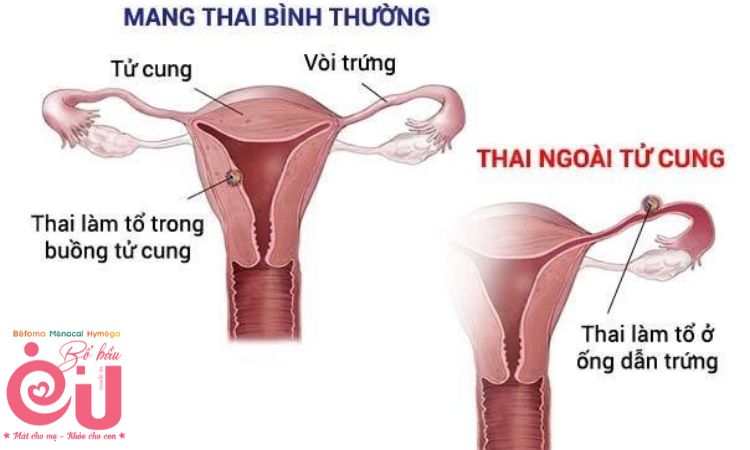 Thai ngoài tử cung chiếm khoảng 2,5% trong các trường hợp ra máu