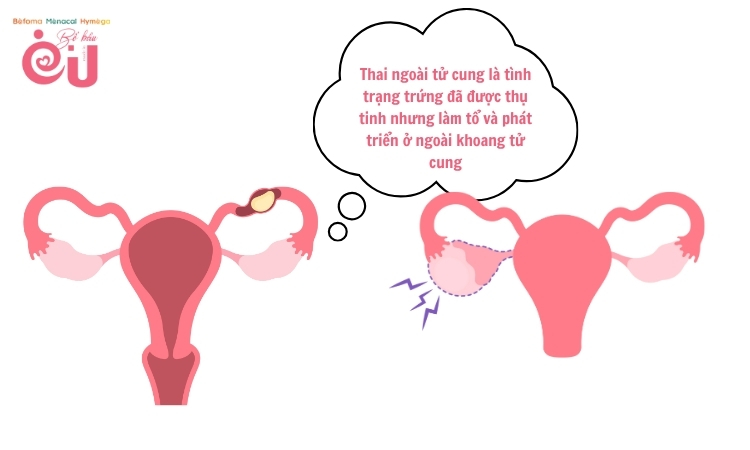 Thai ngoài tử cung là tình trạng trứng làm tổ ở  ngoài khoang tử cung