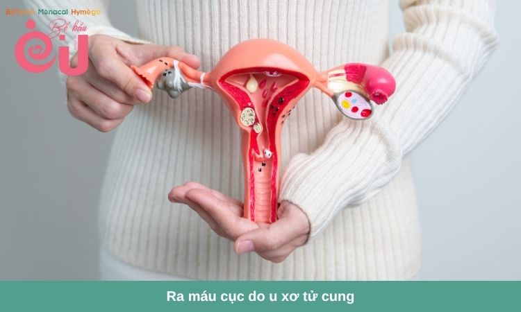 U xơ tử cung là nguyên nhân dẫn đến ra máu cục lớn kèm đau bụng dữ dội