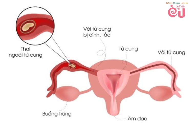 Thai 7 tuần ra máu đỏ tươi do thai ngoài tử cung